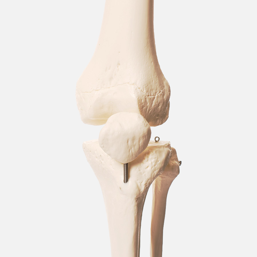 osteoarthritis knee