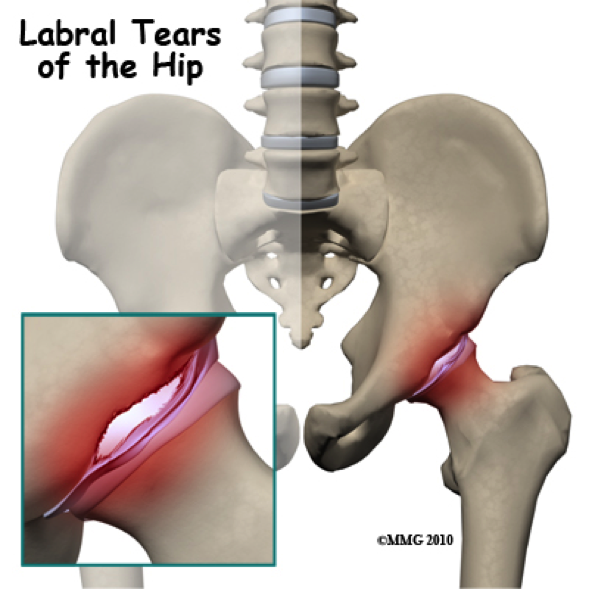 Labral tears of the hip