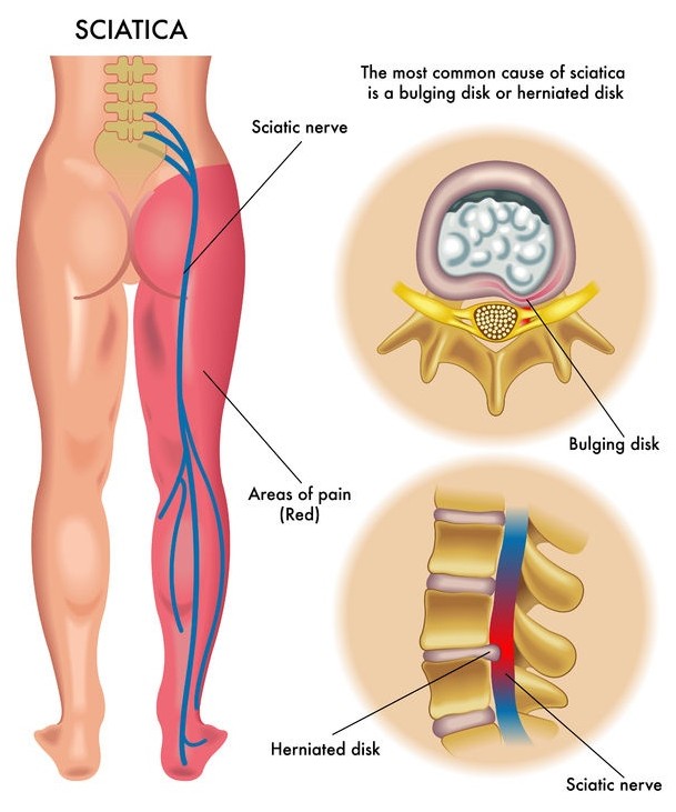 Sciatica Symptoms from Nerve Pain 