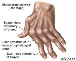 rheumatoid arthritis hand arthritis exercises