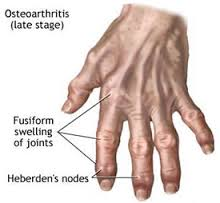 osteoarthritis hand arthritis exercises