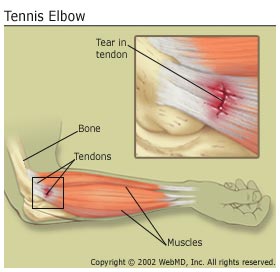 tennis elbow image