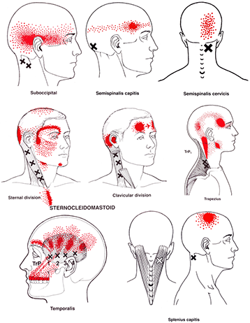 sinus trigger points